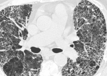 Interstitial lung abnormalities linked to greater risk of all-cause mortality