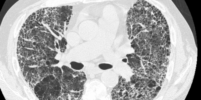 CC/Wiki/Drriad Pulmon_fibrosis