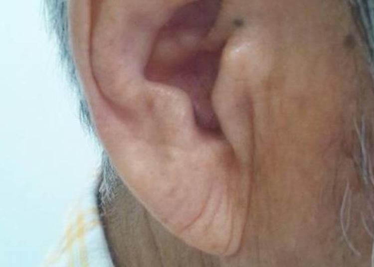 Bilateral diagonal earlobe creases associated with increased risk of coronary artery disease