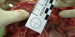 Sodium-glucose cotransporter 2 inhibitors may improve left ventricular diastolic function in hypertrophic cardiomyopathy