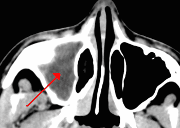 Dupilumab linked to improved symptoms in refractory chronic sinusitis and nasal polyposis