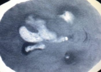 Small-molecule inhibitor may enhance recovery after brain hemorrhage [PreClinical]