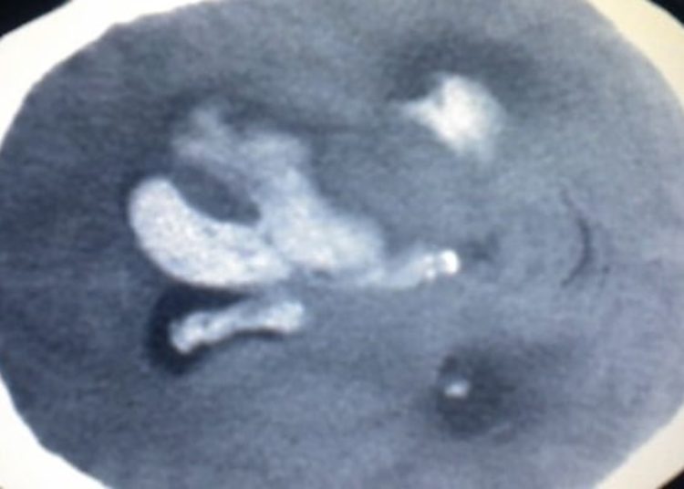 Small-molecule inhibitor may enhance recovery after brain hemorrhage [PreClinical]