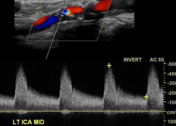 No long-term outcome differences between stenting versus surgery for carotid stenosis