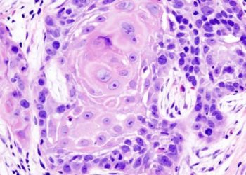 No difference in PET-CT surveillance versus planned neck dissection in advanced head and neck cancer