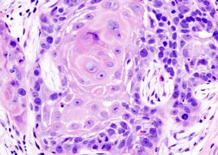 No difference in PET-CT surveillance versus planned neck dissection in advanced head and neck cancer