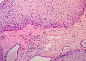 Variability in interpretation of breast biopsy slides associated with low verification of atypia and ductal carcinoma in situ