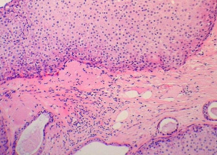 Variability in interpretation of breast biopsy slides associated with low verification of atypia and ductal carcinoma in situ