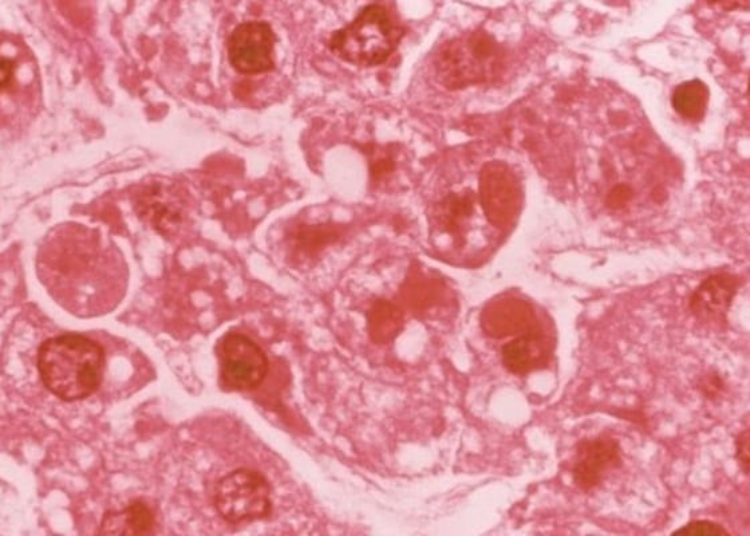 Incidence and severity of dengue in pediatric patients higher in Southeast Asia versus Latin America