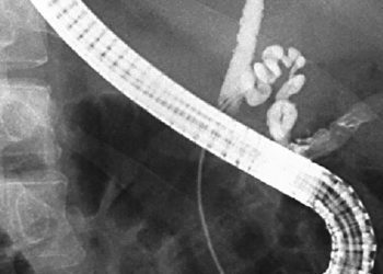 Covered self-expanding metallic stents noninferior to plastic stents in benign biliary strictures