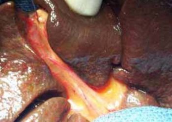 Sonographic triangular cord sign and gallbladder abnormalities diagnostic for biliary atresia