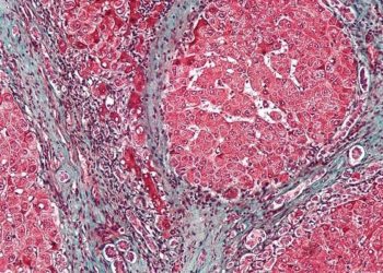 Increasing survival rates for patients with acute liver failure