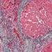 Increasing survival rates for patients with acute liver failure
