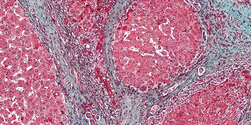 cirrhosis1