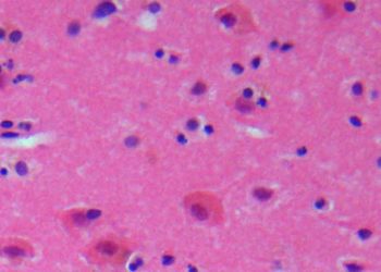 Rapid time to revascularization after ischemic stroke associated with improved functional outcomes