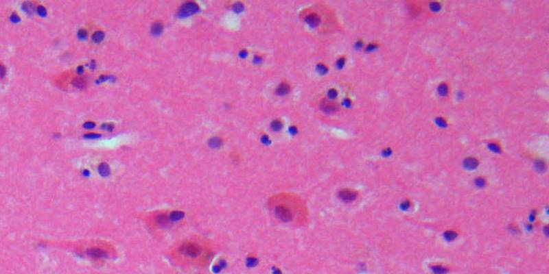 ischemicstroke_cc_wiki_Martin Hasselblatt MD