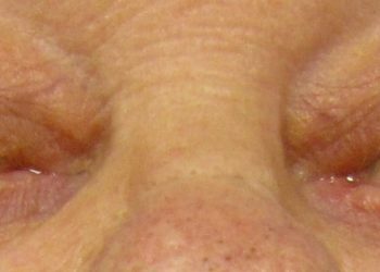 Autologous hematopoietic stem cell transplantation associated with long-term remission in myasthenia gravis