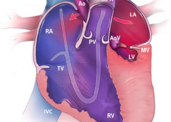 Neurocognitive deficits in congenital heart disease may not worsen with age