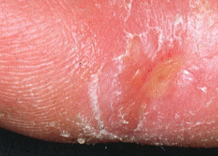 Macitentan does not reduce incidence of ischemic digital ulcers in patients with systemic sclerosis