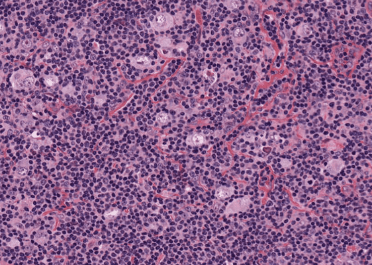 Adaptive interim PET-CT guides treatment for advanced Hodgkin’s lymphoma