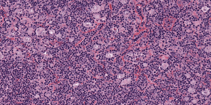 hodgkin-lymphoma