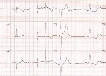 ACE-inhibitor use associated with decreased conduction system disease