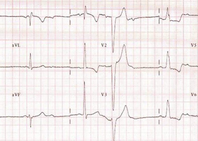 ACE-inhibitor use associated with decreased conduction system disease