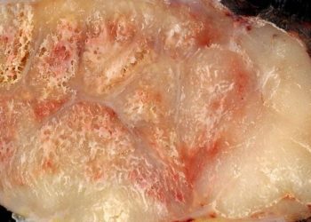 PD-1 blocker pembrolizumab may be a promising therapy for advanced Merkel-cell carcinoma