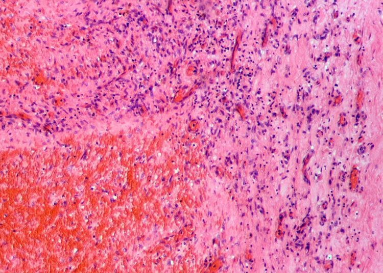 Longer duration of elastic compression therapy may help prevent post-thrombotic syndrome