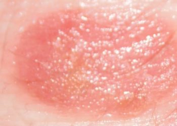 Anti-IL-17A therapy linked to sustained improvement in plaque psoriasis: The UNCOVER trials