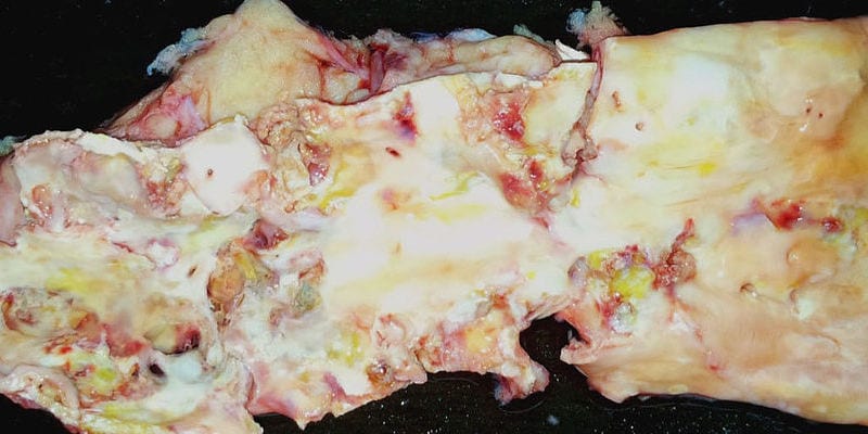 atherosclerosis1