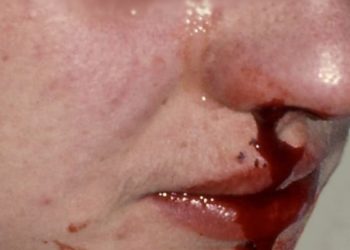 Current therapies ineffective at reducing epistaxis in hereditary hemorrhagic telangiectasia