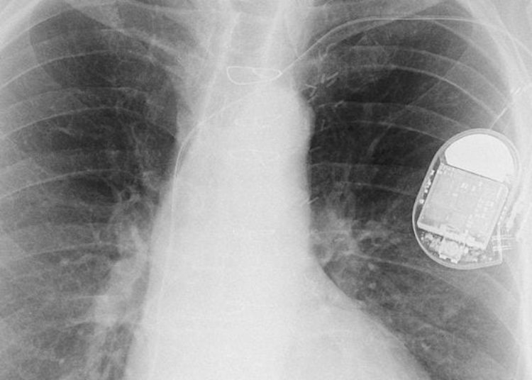 No survival benefit with ICDs in non-ischemic systolic heart failure: The DANISH trial