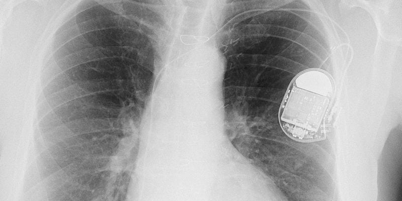 implanted-cardiac-defib-icd
