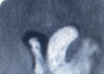 No difference in mortality for intensive versus standard reduction in blood pressure in intracerebral hemorrhage: The ATACH-2 trial