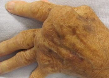 Non-TNF-targeted therapies more effective than anti-TNF agents in uncontrolled rheumatoid arthritis