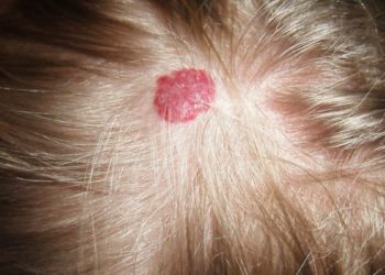 Autosomal dominant, maternal inheritance of infantile hemangioma