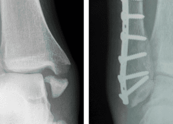 Casting versus surgery for ankle fractures in older adults