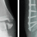 Casting versus surgery for ankle fractures in older adults