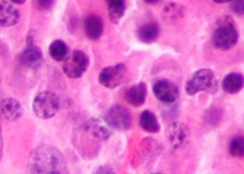 Adding daratumumab increases progression free survival in multiple myeloma