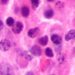 Adding daratumumab increases progression free survival in multiple myeloma
