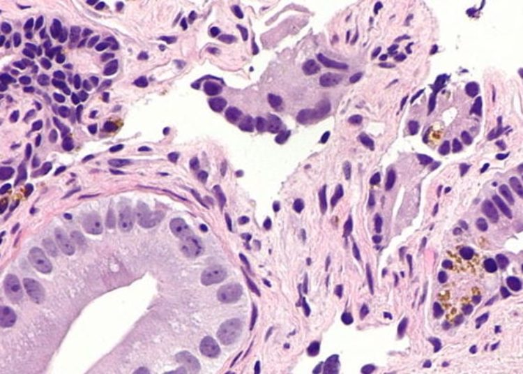 Patient-reported outcomes differ significantly based on treatment in prostate cancer: The ProtecT trial