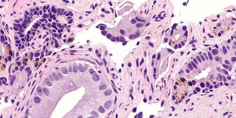 prostate-cancer