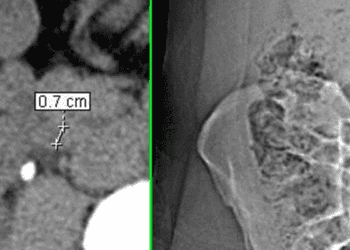 Contrast-enhanced computed tomography associated with high sensitivity to renal stone detection