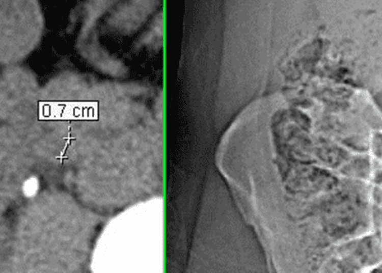 Contrast-enhanced computed tomography associated with high sensitivity to renal stone detection