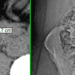 Contrast-enhanced computed tomography associated with high sensitivity to renal stone detection