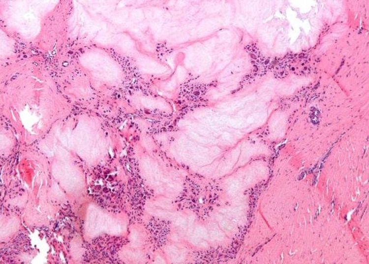 ACP releases clinical practice guidelines for acute gout