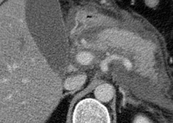 Mild-to-moderate hypertriglyceridemia associated with higher risk of acute pancreatitis