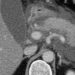 Mild-to-moderate hypertriglyceridemia associated with higher risk of acute pancreatitis