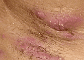 Hidradenitis suppurativa associated with increased risk of subclinical atherosclerosis